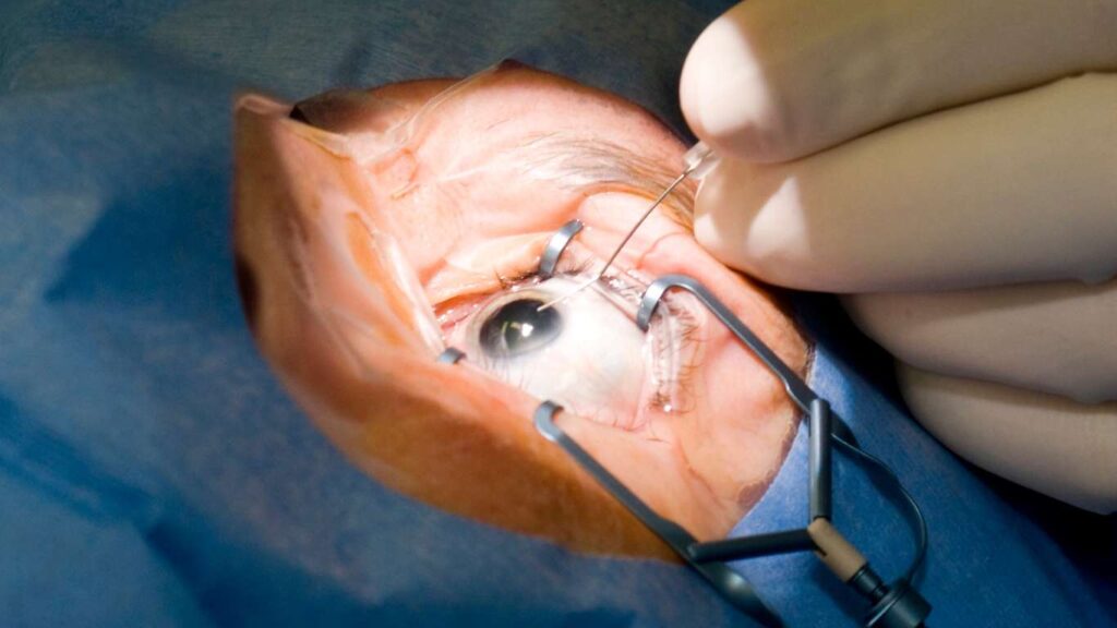 eye surgery